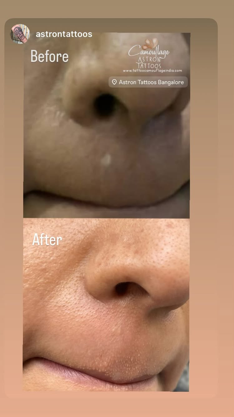 Skin tone scar blending tattoo Bangalore