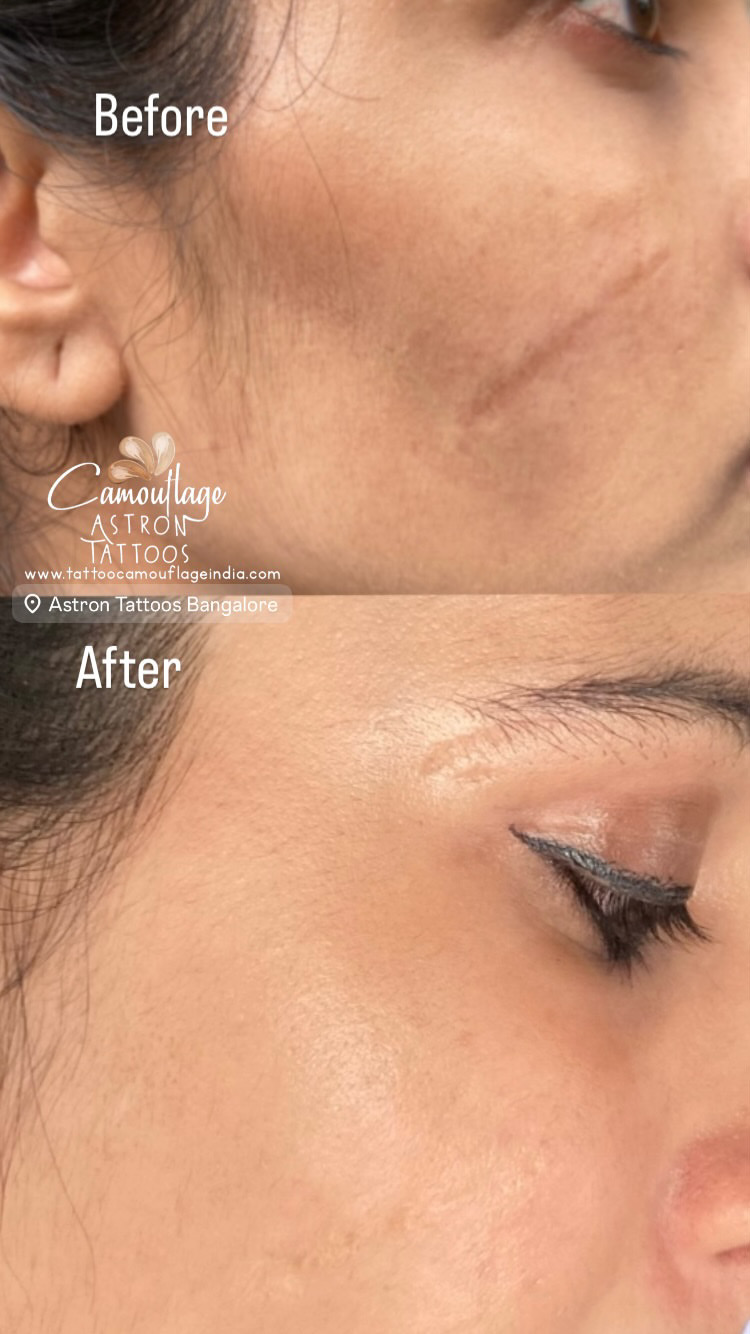 Stretch mark camouflage tattoo result India