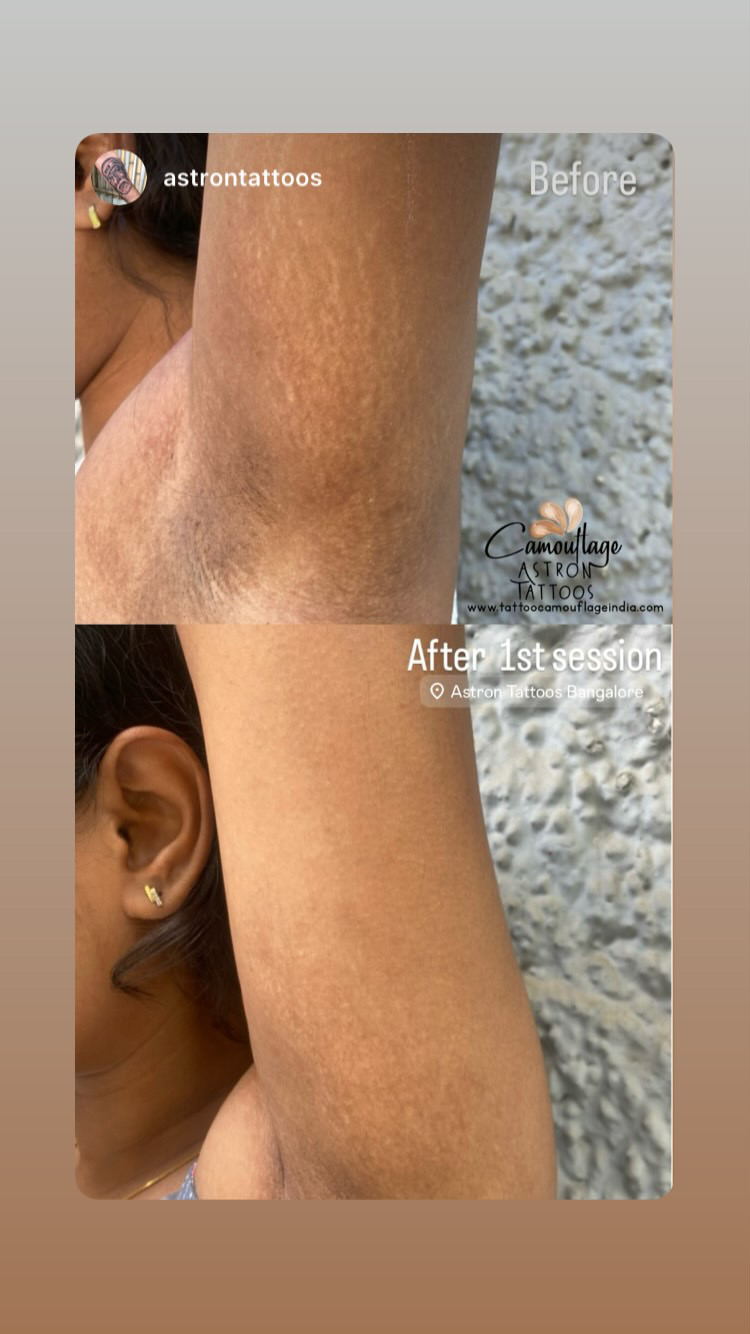 Stretch mark camouflage tattoo result India