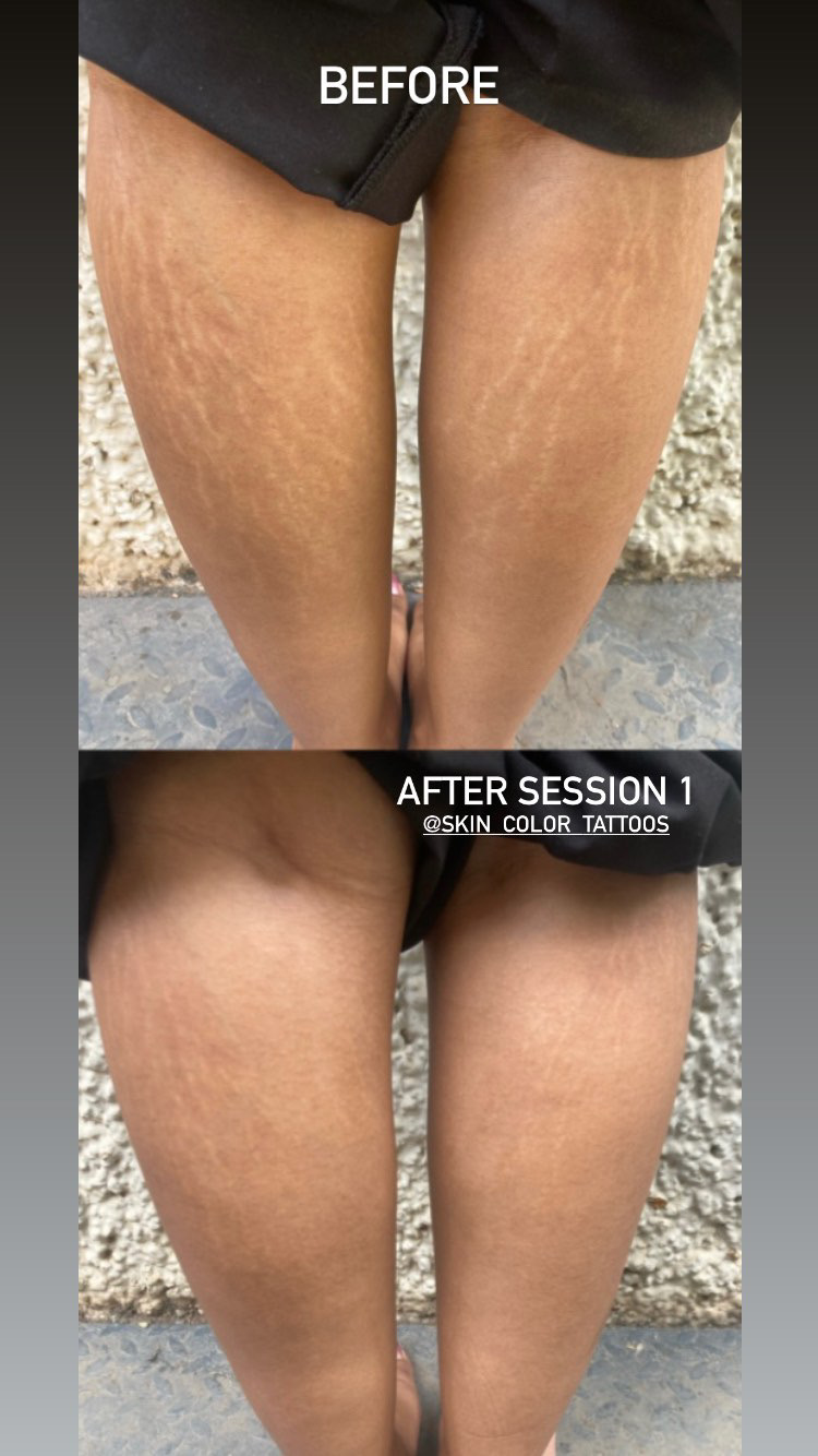 Scar camouflage tattoo before and after Bangalore