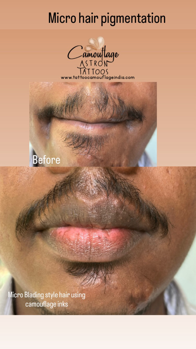 Micro hair pigmentation cosmetic tattooing for facial scars Bangalore