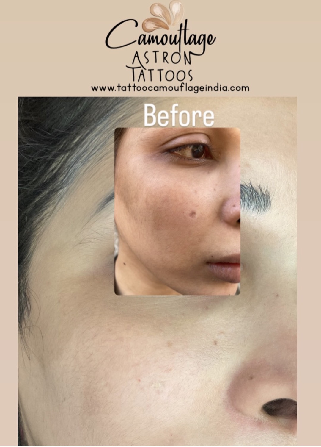 Camouflage tattoo cosmetic tattooing result India